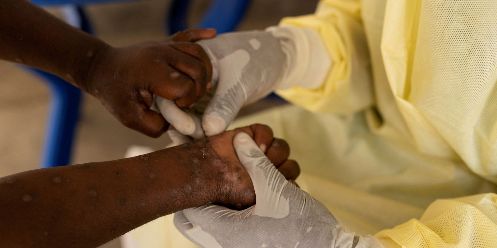 Mpox: saiba quais doenças já tiveram mais alto nível de alerta global